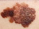 Melanoma